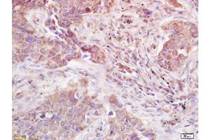 Formalin-fixed and paraffin embedded human lung carcinoma labeled with Anti-ADAMTS12 Polyclonal Antibody, Unconjugated (ABIN685792) at 1:200 followed by conjugation to the secondary antibody and DAB staining.
