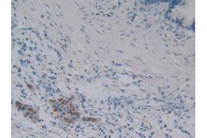 Detection of iPLA2 in Human Pancreas Tissue using Polyclonal Antibody to Phospholipase A2, Calcium Independent (iPLA2)