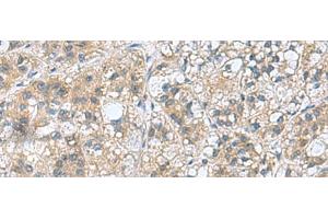 Immunohistochemistry of paraffin-embedded Human liver cancer tissue using RAB39A Polyclonal Antibody at dilution of 1:70(x200)