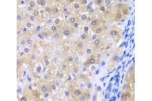 Immunohistochemistry of paraffin-embedded Human liver damage using GPX4 Polyclonal Antibody at dilution of 1:200 (40x lens).