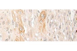 Immunohistochemistry of paraffin-embedded Human esophagus cancer tissue using DDX24 Polyclonal Antibody at dilution of 1:35(x200)