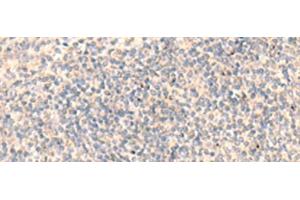 Immunohistochemistry of paraffin-embedded Human tonsil tissue using ADAMTS2 Polyclonal Antibody at dilution of 1:45(x200)