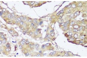 Immunohistochemistry of paraffin-embedded Human liver cancer using FKBP10 Polyclonal Antibody at dilution of 1:150 (40x lens).
