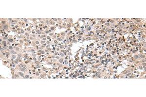 Immunohistochemistry of paraffin-embedded Human cervical cancer tissue using TDP2 Polyclonal Antibody at dilution of 1:75(x200)