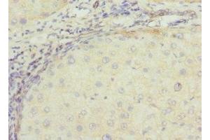 Immunohistochemistry of paraffin-embedded human liver cancer using ABIN7171838 at dilution of 1:100