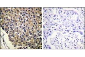 Immunohistochemistry analysis of paraffin-embedded human breast carcinoma, using IL-8R beta/CDw128 beta (Phospho-Ser347) Antibody.