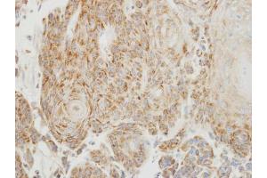 IHC-P Image Immunohistochemical analysis of paraffin-embedded human oral cancer, using PGP9.