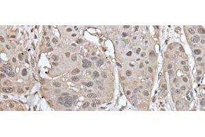 Immunohistochemistry of paraffin-embedded Human esophagus cancer tissue using UBASH3A Polyclonal Antibody at dilution of 1:50(x200)