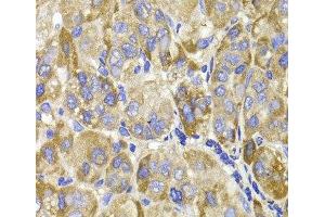 Immunohistochemistry of paraffin-embedded Human liver cancer using MAGED1 Polyclonal Antibody at dilution of 1:100 (40x lens).