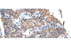 Immunohistochemistry of paraffin-embedded Human lung cancer tissue using PPBP Polyclonal Antibody at dilution of 1:35(x200)