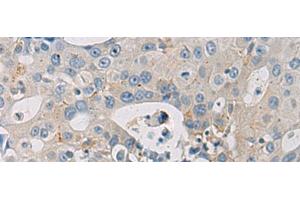Immunohistochemistry of paraffin-embedded Human breast cancer tissue using WFDC3 Polyclonal Antibody at dilution of 1:40(x200)