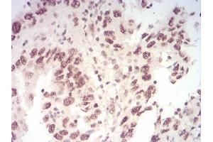 Immunohistochemical analysis of paraffin-embedded endometrial cancer tissues using WTAP mouse mAb with DAB staining.