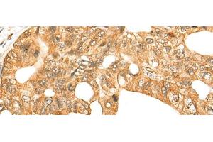 Immunohistochemistry of paraffin-embedded Human gastric cancer tissue using CDCA4 Polyclonal Antibody at dilution of 1:70(x200)