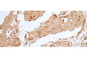 Immunohistochemistry of paraffin-embedded Human esophagus cancer tissue using HOXC9 Polyclonal Antibody at dilution of 1:35(x200)