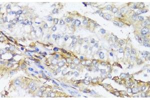 Immunohistochemistry of paraffin-embedded Human colon carcinoma using HLA-DPB1 Polyclonal Antibody at dilution of 1:100 (40x lens).