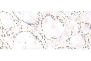 Immunohistochemistry of paraffin-embedded Human thyroid cancer tissue using ARL2BP Polyclonal Antibody at dilution of 1:50(x200)