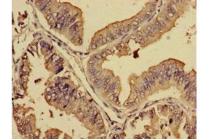 Immunohistochemistry of paraffin-embedded human endometrial cancer using ABIN7164730 at dilution of 1:100