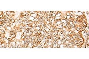 Immunohistochemistry of paraffin-embedded Human gastric cancer tissue using NR0B2 Polyclonal Antibody at dilution of 1:35(x200)