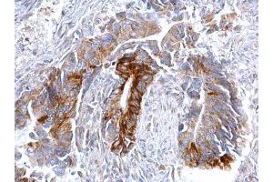 IHC-P Image CCR3 antibody [C2C3], C-term detects CCR3 protein at cytosol on human colon carcinoma by immunohistochemical analysis.