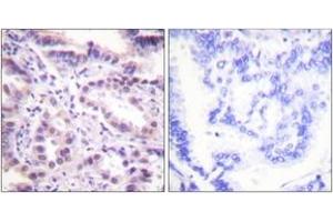 Immunohistochemistry analysis of paraffin-embedded human lung carcinoma, using ERF (Phospho-Thr526) Antibody.