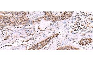 Immunohistochemistry of paraffin-embedded Human esophagus cancer tissue using CUL4A Polyclonal Antibody at dilution of 1:55(x200)