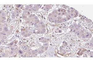 ABIN6273934 at 1/100 staining Human liver cancer tissue by IHC-P.