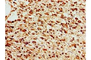 Immunohistochemistry of paraffin-embedded human glioma using ABIN7172611 at dilution of 1:100