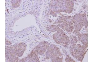 IHC-P Image Immunohistochemical analysis of paraffin-embedded human breast cancer, using Peroxiredoxin 2, antibody at 1:500 dilution.