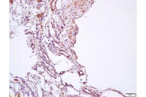 Formalin-fixed and paraffin embedded human lung carcinoma labeled with Anti-phospho-AMPK beta 1 (Ser182) Polyclonal Antibody, Unconjugated (ABIN683068) at 1:200 followed by conjugation to the secondary antibody and DAB staining