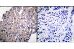 Immunohistochemistry analysis of paraffin-embedded human breast carcinoma, using PLCG1 (Phospho-Tyr771) Antibody.