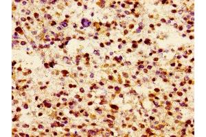 Immunohistochemistry of paraffin-embedded human glioma using ABIN7157174 at dilution of 1:100