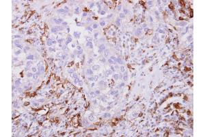 IHC-P Image Iba1 antibody detects Iba1 protein at cytoplasm on human breast cancer stroma by immunohistochemical analysis.