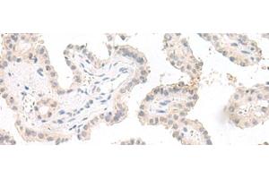 Immunohistochemistry of paraffin-embedded Human thyroid cancer tissue using GHDC Polyclonal Antibody at dilution of 1:90(x200)