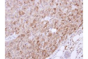 IHC-P Image Immunohistochemical analysis of paraffin-embedded CL1-5 xenograft, using VGAT, antibody at 1:500 dilution.