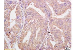 Formalin-fixed and paraffin embedded human colon carcinoma labeled with Rabbit Anti Phospho-BRCA1(Ser1524) Polyclonal Antibody, Unconjugated (ABIN682903) at 1:200 followed by conjugation to the secondary antibody and DAB staining