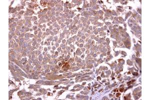 IHC-P Image Glycophorin A antibody [C1C3] detects Glycophorin A protein at cytosol on human lung carcinoma by immunohistochemical analysis.