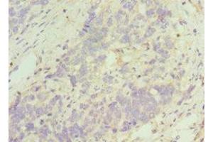 Immunohistochemistry of paraffin-embedded human endometrial cancer using ABIN7161335 at dilution of 1:100