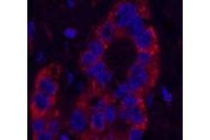 Immunofluorescence analysis of Human liver cancer tissue using NFKBIB Monoclonal Antibody at dilution of 1:200.