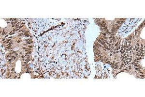 Immunohistochemistry of paraffin-embedded Human colorectal cancer tissue using ZNF787 Polyclonal Antibody at dilution of 1:45(x200)