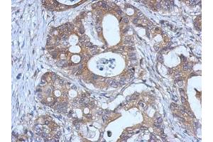 IHC-P Image Immunohistochemical analysis of paraffin-embedded human gastric cancer, using GPX2, antibody at 1:500 dilution.
