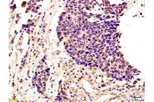 Formalin-fixed and paraffin embedded human lung cancer labeled with Anti-SNAI2/SLUG Polyclonal Antibody, Unconjugated (ABIN685747) followed by conjugation to the secondary antibody and DAB staining