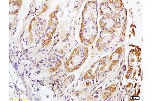Formalin-fixed and paraffin embedded human lung carcinoma labeled with Rabbit Anti NALP4 Polyclonal Antibody, Unconjugated (ABIN872353) at 1:200 followed by conjugation to the secondary antibody and DAB staining