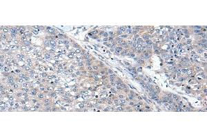 Immunohistochemistry of paraffin-embedded Human liver cancer tissue using WIF1 Polyclonal Antibody at dilution of 1:100(x200)