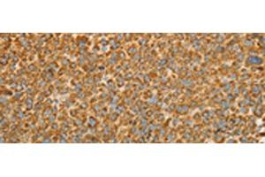 Immunohistochemistry of paraffin-embedded Human liver cancer tissue using VDAC2 Polyclonal Antibody at dilution of 1:25(x200)