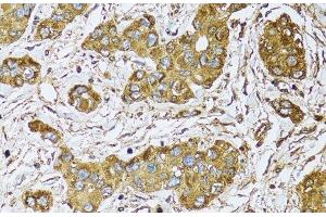 Immunohistochemistry of paraffin-embedded Human liver cancer using UGDH Polyclonal Antibody at dilution of 1:100 (40x lens).