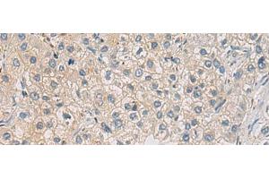 Immunohistochemistry of paraffin-embedded Human liver cancer tissue using WFDC3 Polyclonal Antibody at dilution of 1:40(x200)