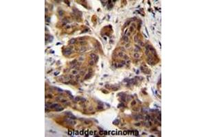 C4orf21 Antibody (N-term) immunohistochemistry analysis in formalin fixed and paraffin embedded human bladder carcinoma followed by peroxidase conjugation of the secondary antibody and DAB staining.