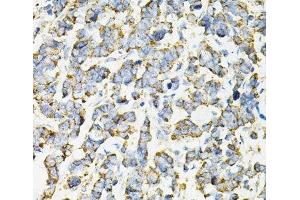 Immunohistochemistry of paraffin-embedded Human lung cancer using ADSS Polyclonal Antibody at dilution of 1:100 (40x lens).