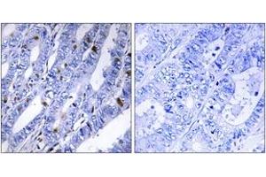 Immunohistochemistry analysis of paraffin-embedded human colon carcinoma tissue, using PKA-R2 beta (Ab-113) Antibody.