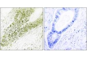 Immunohistochemistry analysis of paraffin-embedded human colon carcinoma tissue, using Ubinuclein Antibody.
